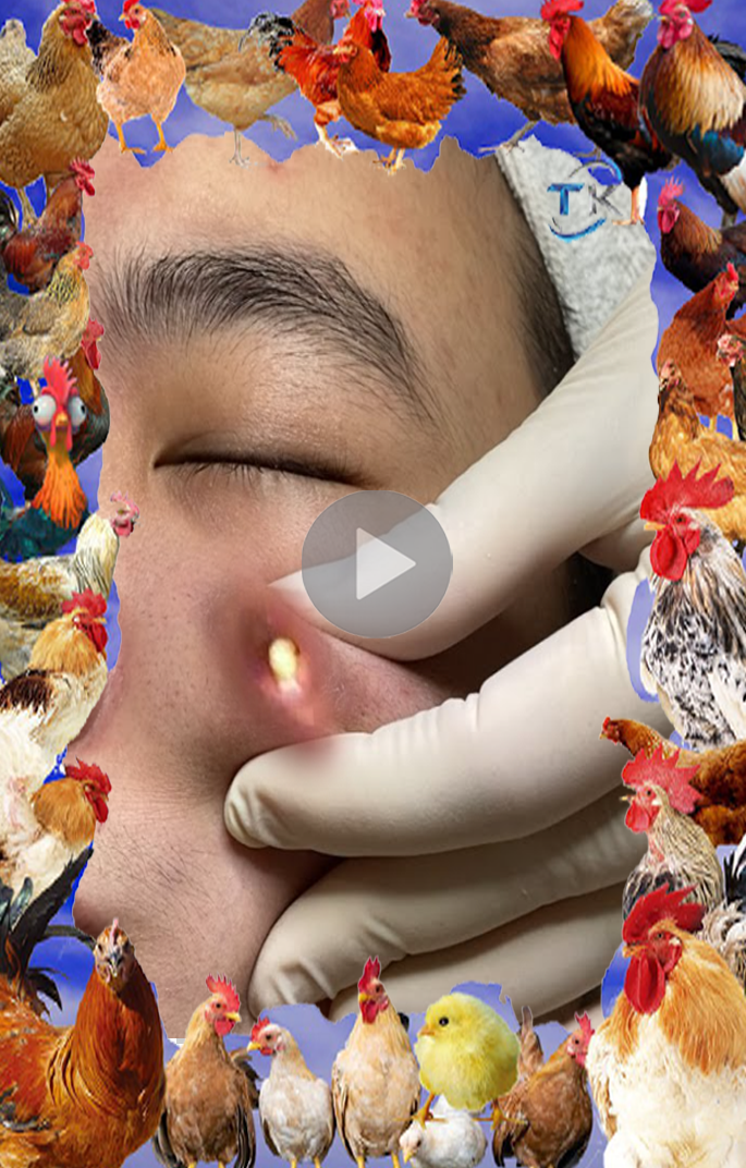 Blackhead Popping Videos Affect Viewers